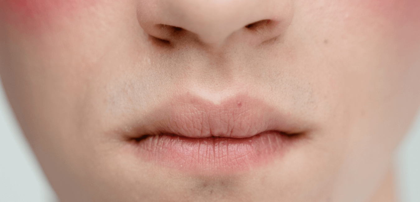 How to Get Rid of Whiteheads Around Lips?