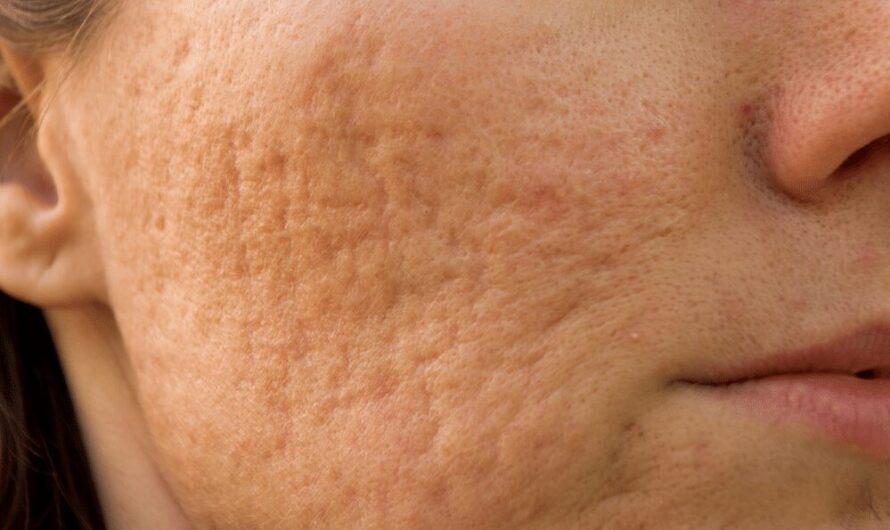 Can Collagen Cause Acne?