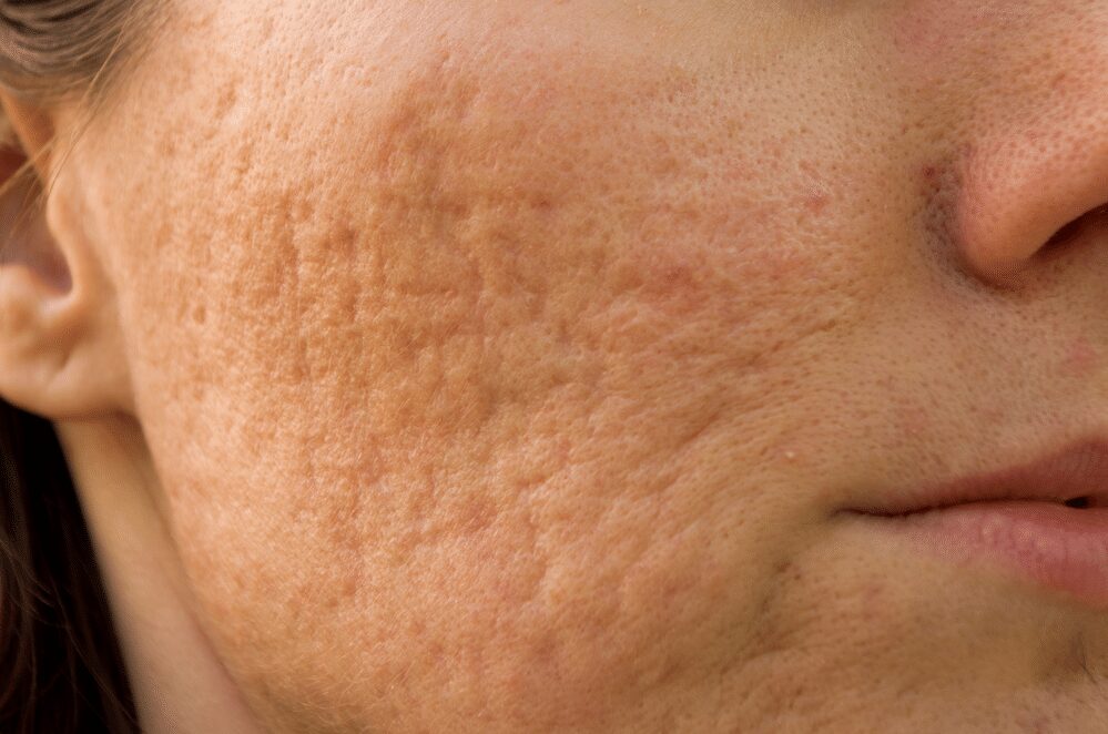 Can Collagen Cause Acne?