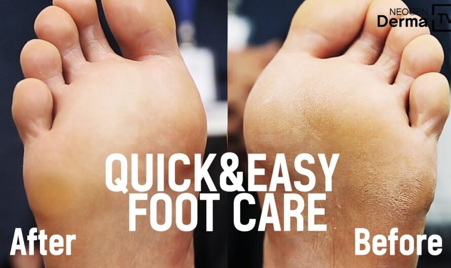 How to remove thick dead skin from feet