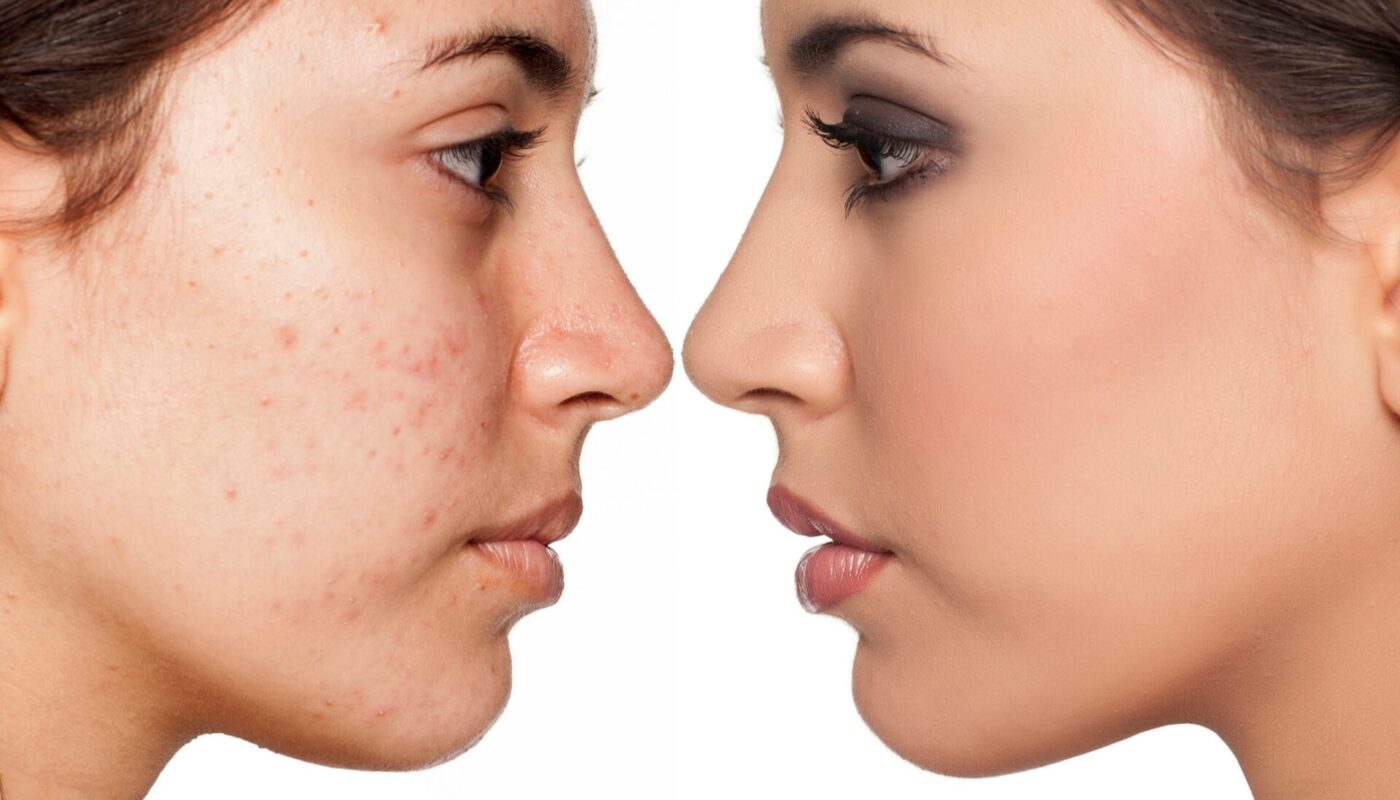 How long does doxycycline take to work for acne