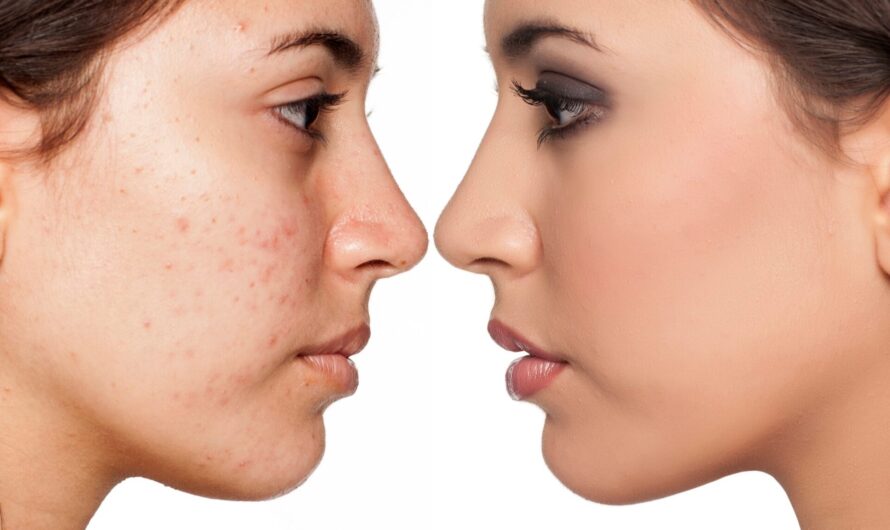 How long does doxycycline take to work for acne