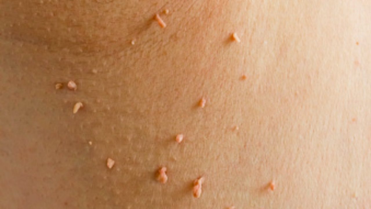 What are skin tags?