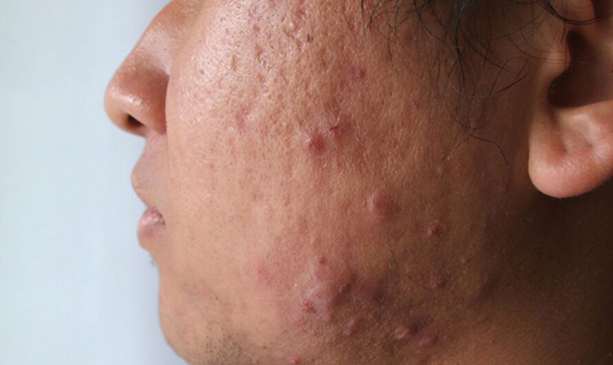 What supplements can cause acne