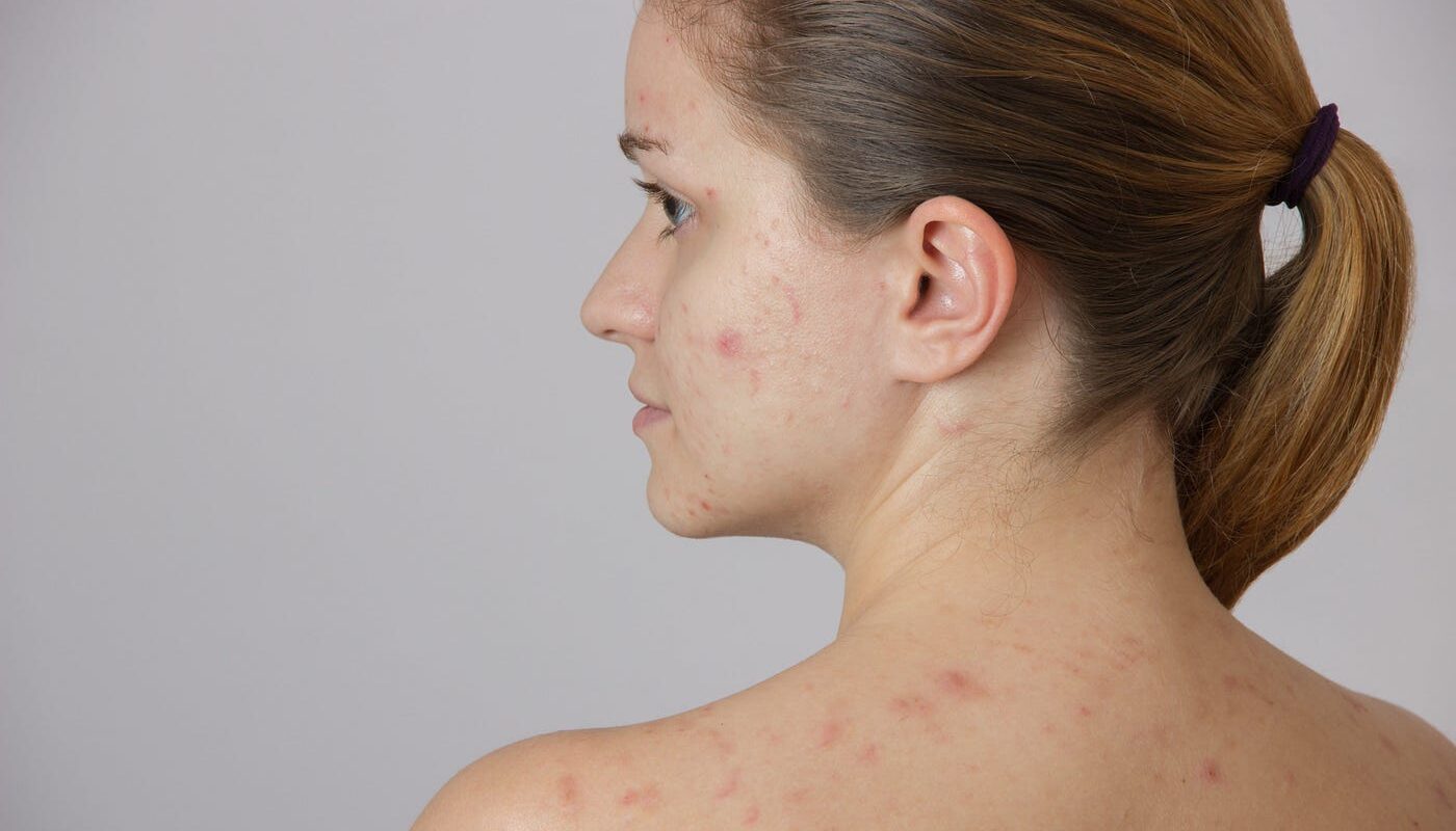 How Much Vitamin B5 for Acne?